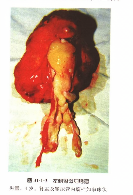 左侧肾母细胞瘤