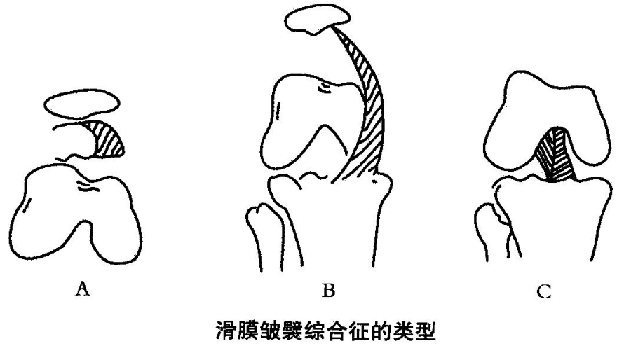 滑膜皱襞综合征的类型