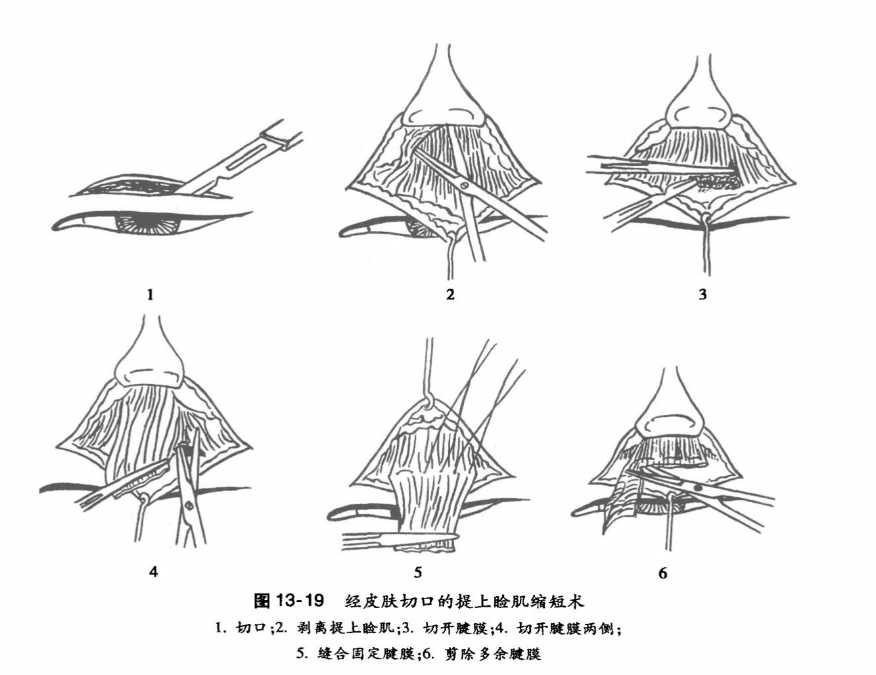 经皮肤切口的提上脸肌缩短术