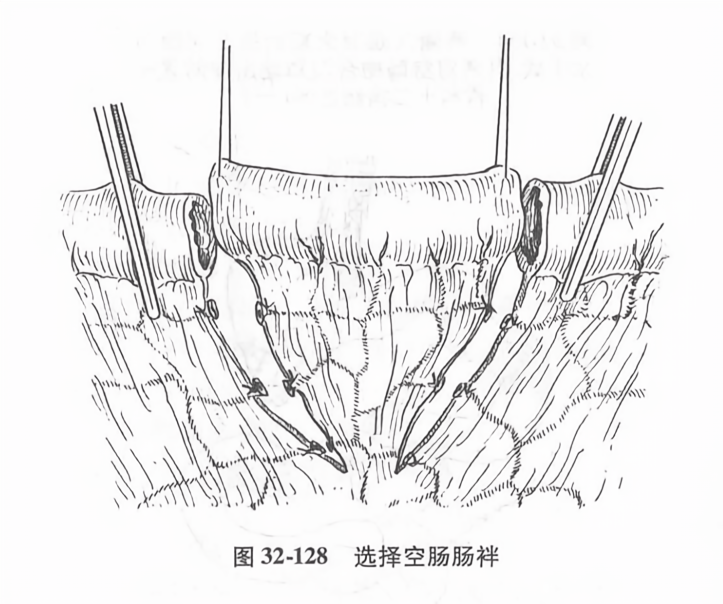 选择空肠肠袢