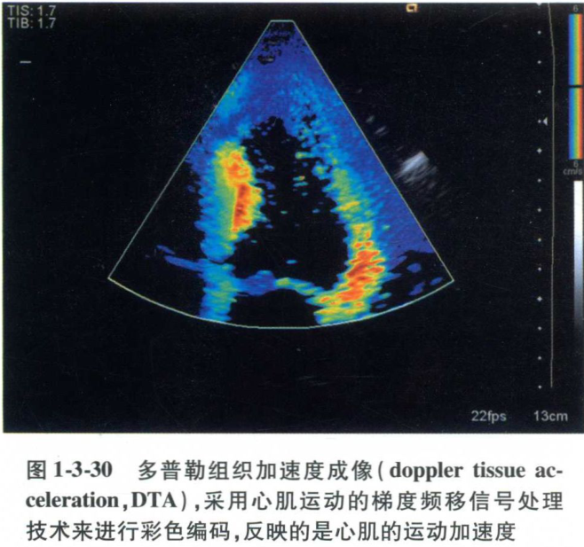 图1-3-30 多普勒组织加速度成像(doppler tissue ac-celeration, d
