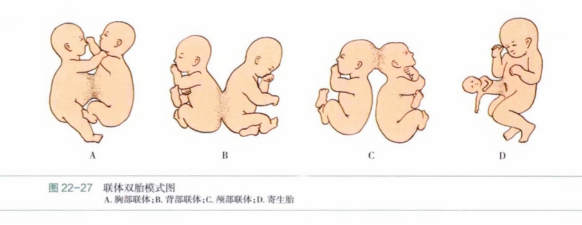 联体双胎模式图