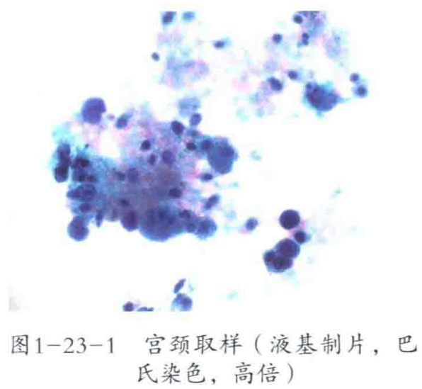 图1-23-1 宫颈取样(液基制片,巴氏染色,高倍)