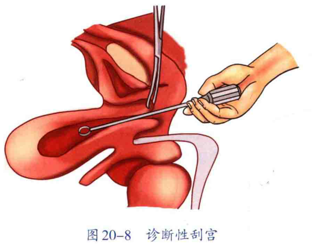 图 20-8 诊断性刮宫
