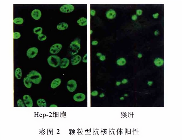 颗粒型抗核抗体阳性