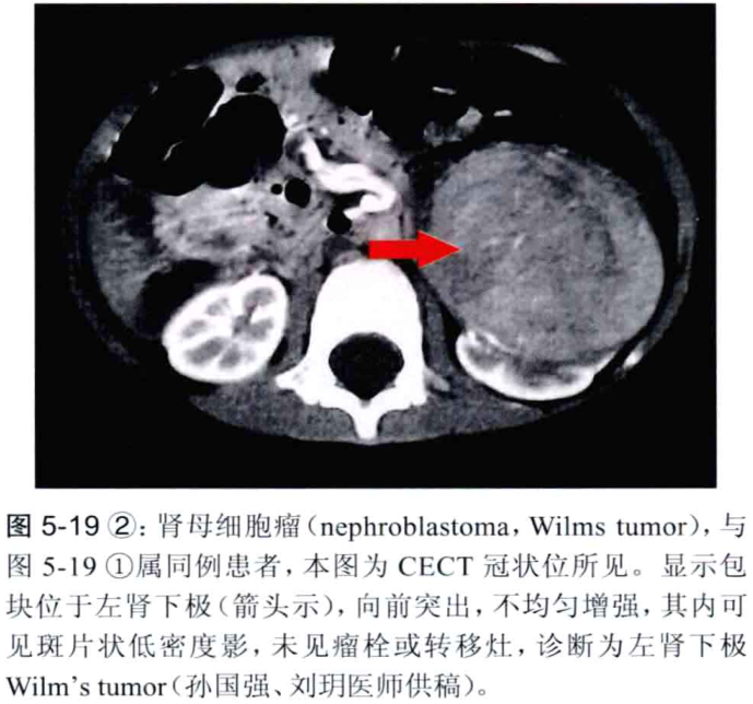 图5-19 2:肾母细胞瘤(nephroblastoma, wilms tumor),与 图5-19