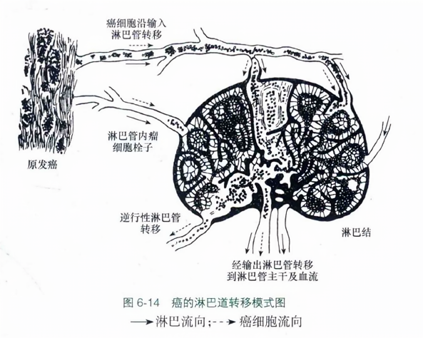 癌的淋巴道转移模式图