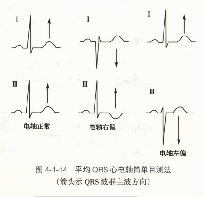 平均 qrs心电轴简单目测法