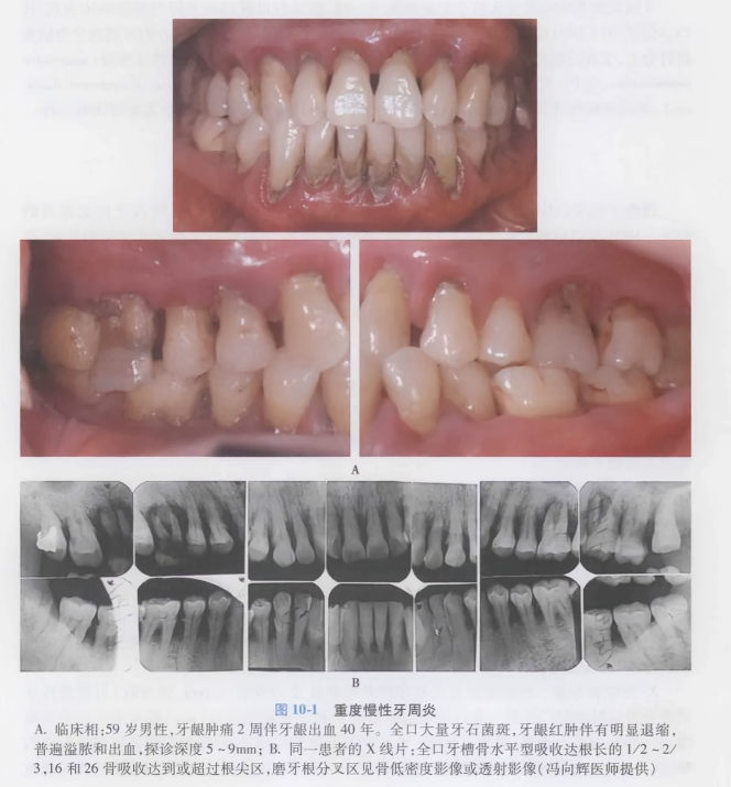 重度慢性牙周炎