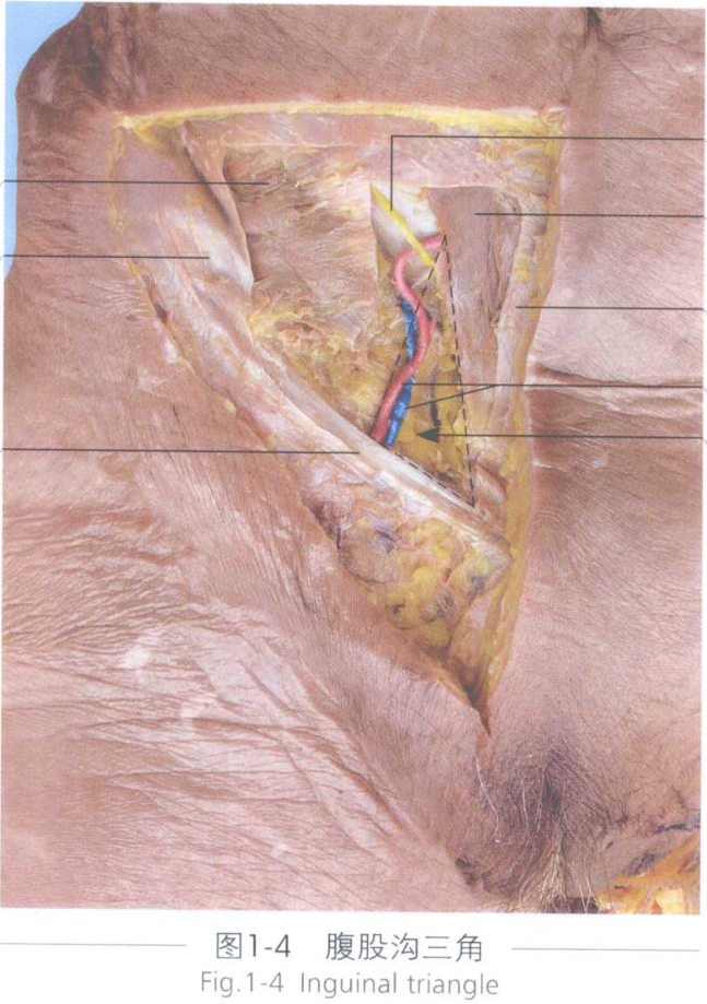 图1-4 腹股沟三角 fig.1-4 inguinal triangle