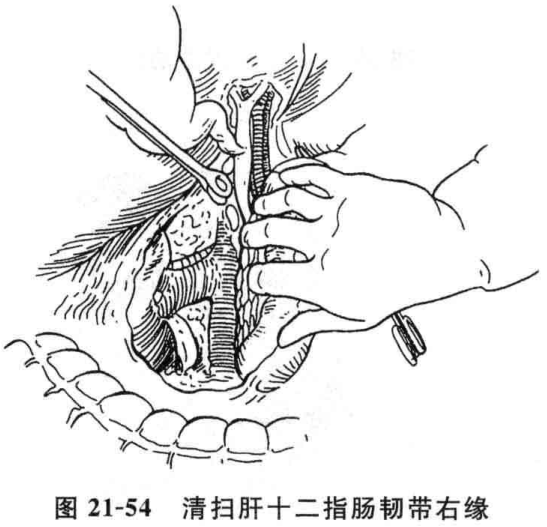 图21-54 清扫肝十二指肠韧带右缘