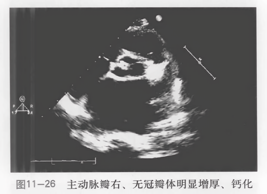 主动脉瓣右、无冠瓣体明显增厚、钙化