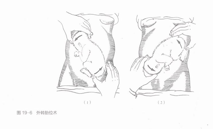 外转胎位术