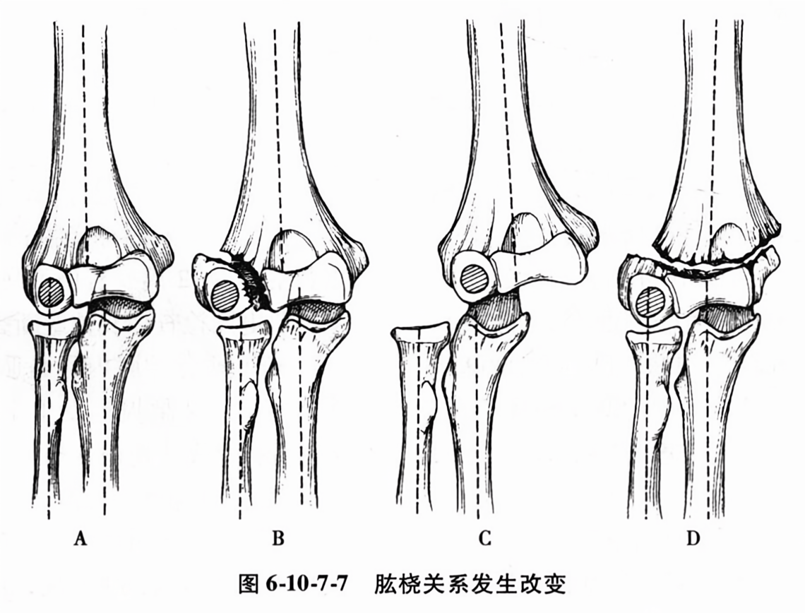 肱桡关系发生改变