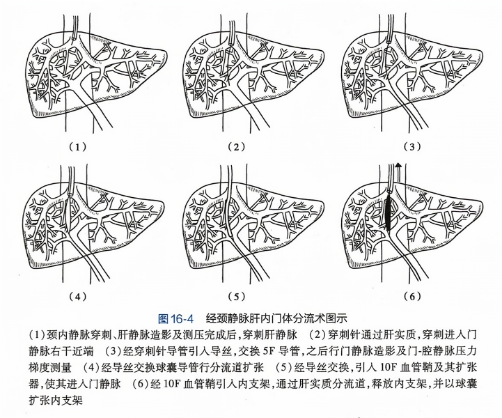 经颈静脉肝内门体分流术图示