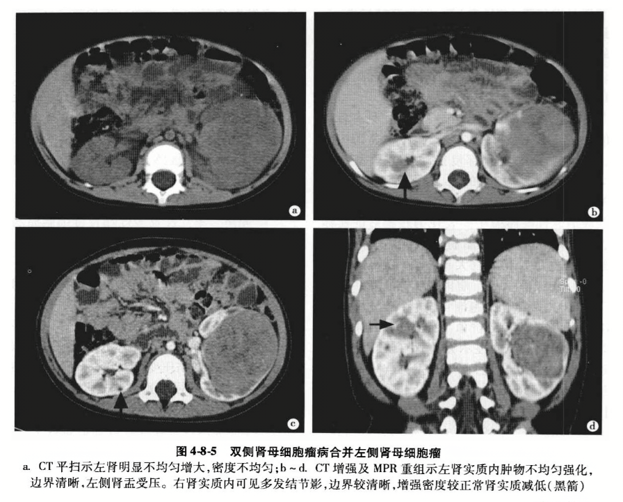 双侧肾母细胞瘤病合并左侧肾母细胞瘤