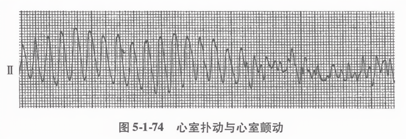 心室扑动与心室颤动