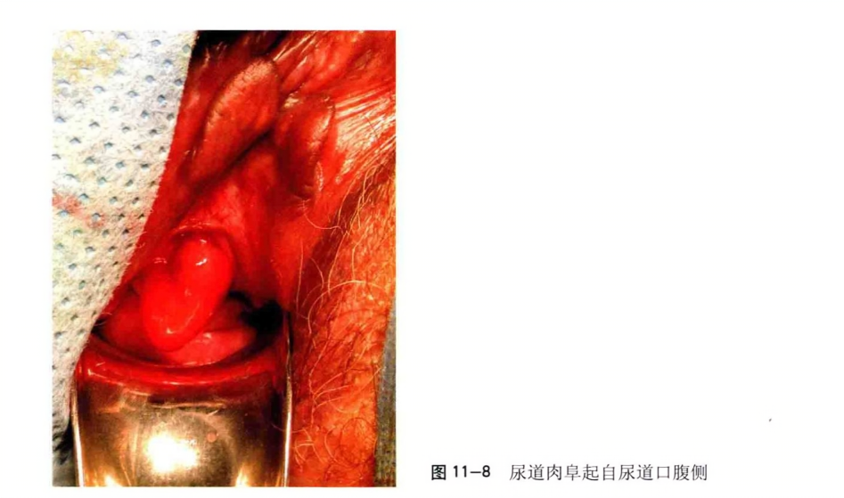 尿道肉阜起自尿道口腹侧