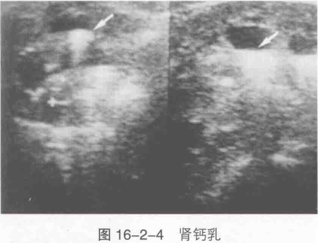 图16-2-4 肾钙乳