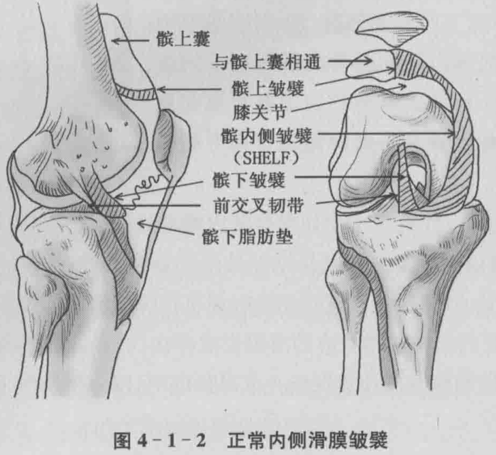 图4-1-2 正常内侧滑膜皱襞