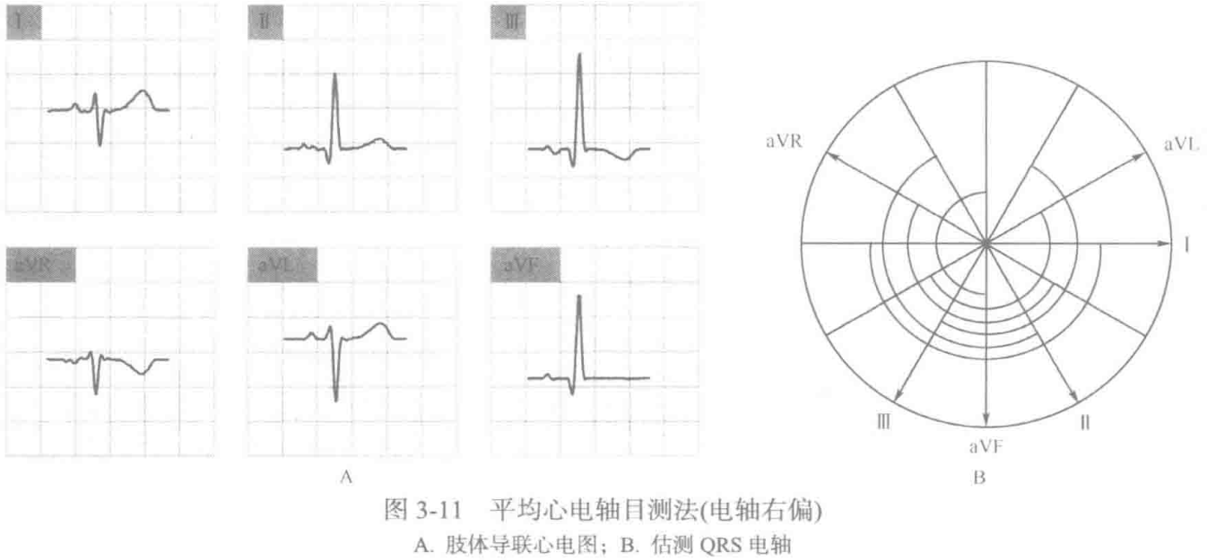 图3-11 平均心电轴目测法(电轴右偏) a.肢体导联心电图;b.估测qrs 电轴