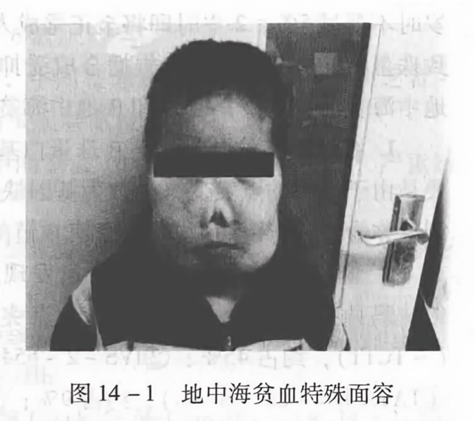 地中海贫血特殊面容