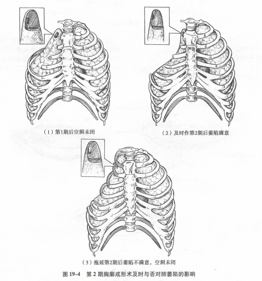 第2期胸廓成形术及时与否对肺萎陷的影响