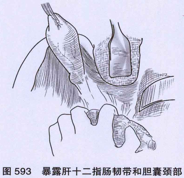 图593 暴露肝十二指肠韧带和胆囊颈部