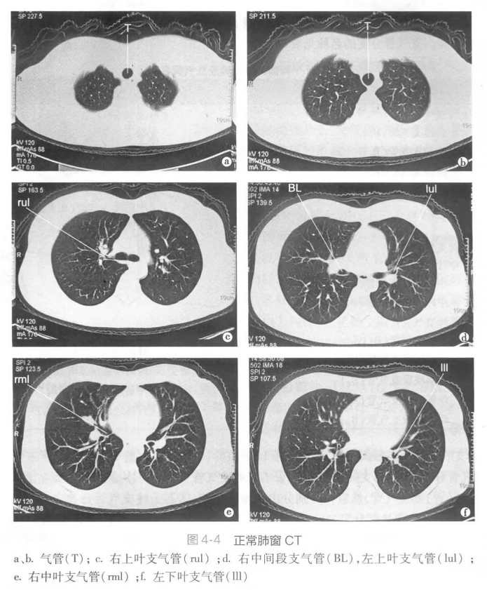 正常肺窗 ct