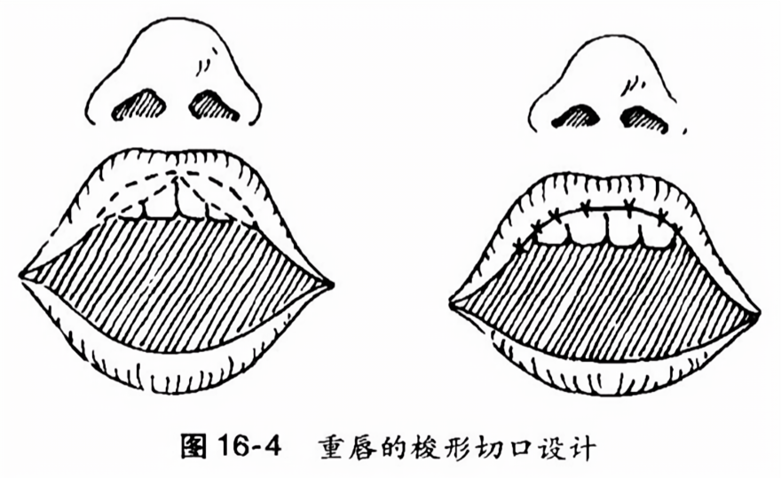 重唇的梭形切口设计