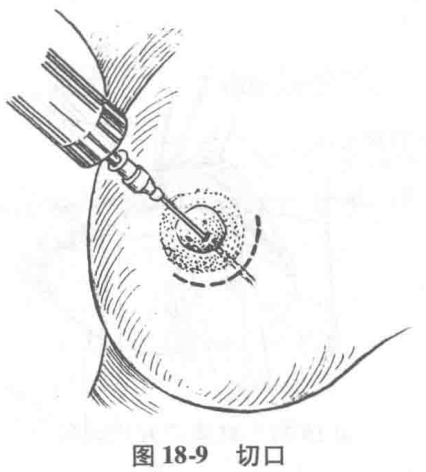 图18-9 切口