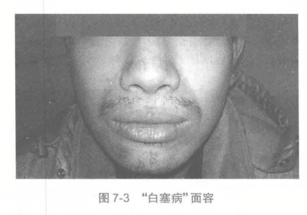 -白塞病-面容