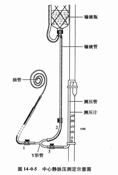 中心静脉压测定示意图