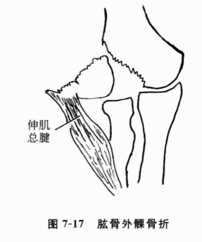 肱骨外骨折