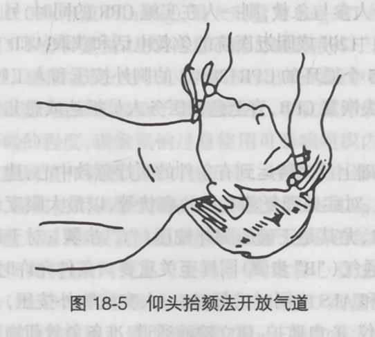 仰头抬颏法开放气道