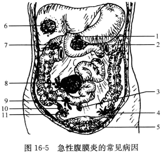 图16-5 急性腹膜炎的常见病因