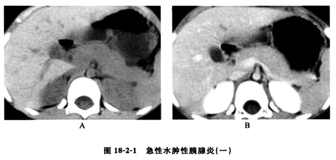 急性水肿性胰腺炎(一)