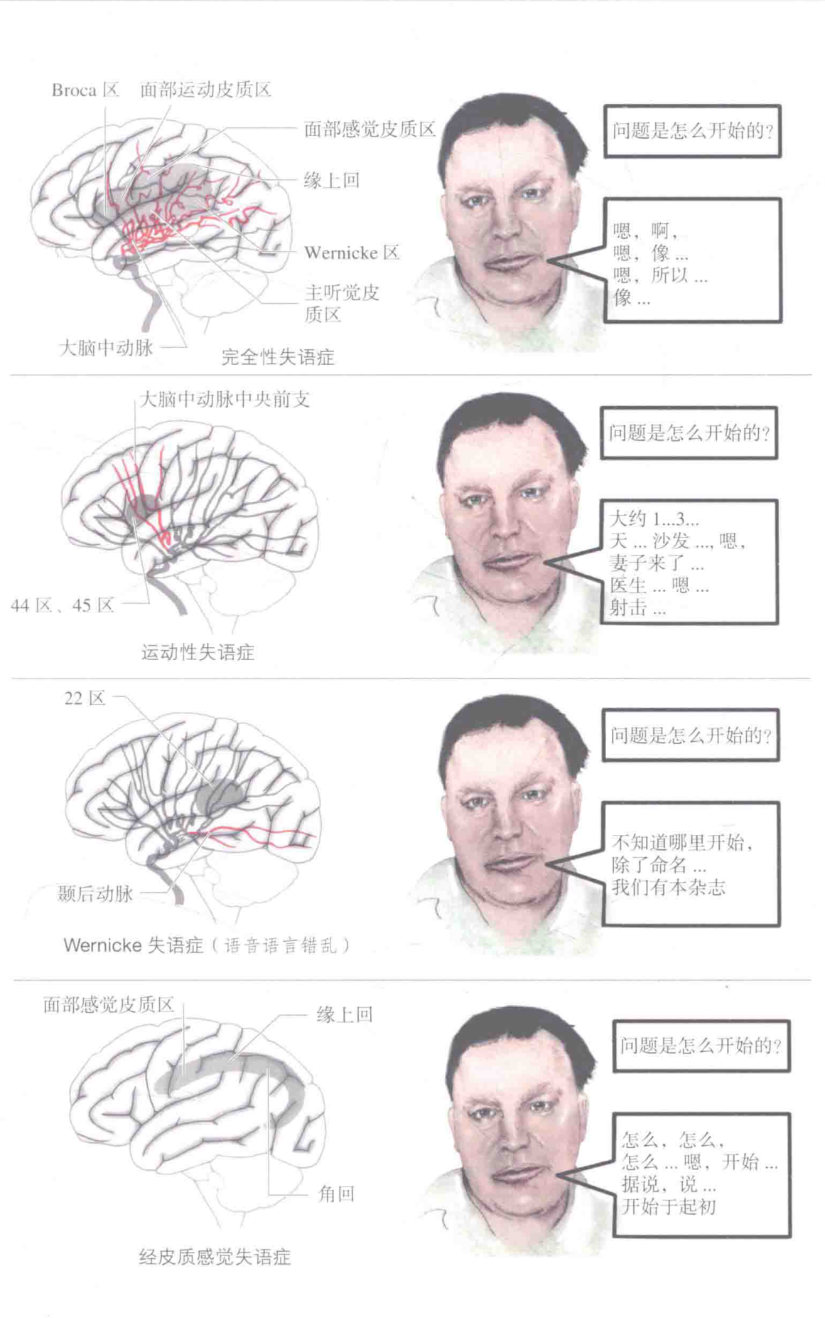 运动性失语症