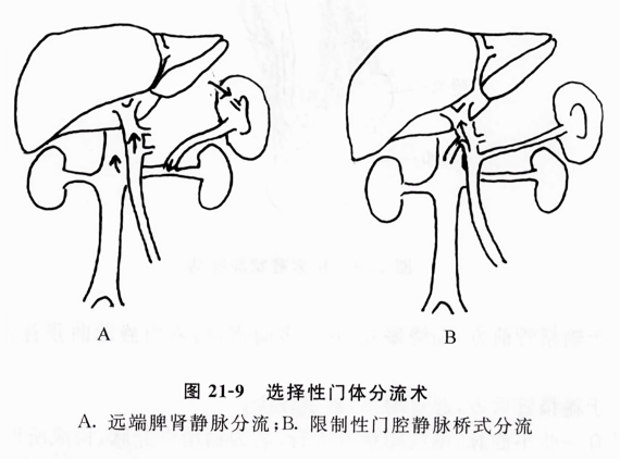 选择性门体分流术