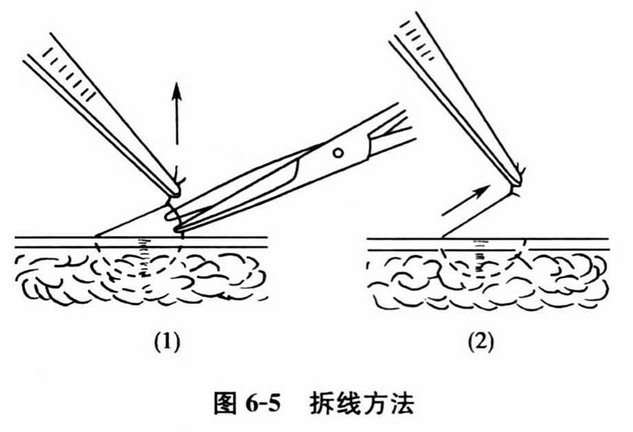 拆线方法