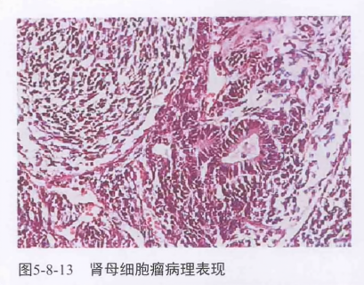 肾母细胞瘤病理表现
