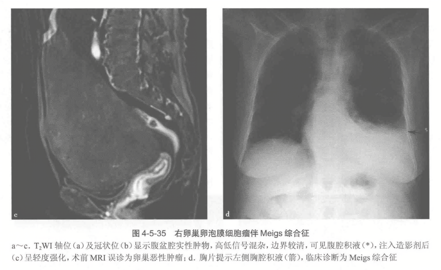右卵巢卵泡膜细胞瘤伴 meigs 综合征