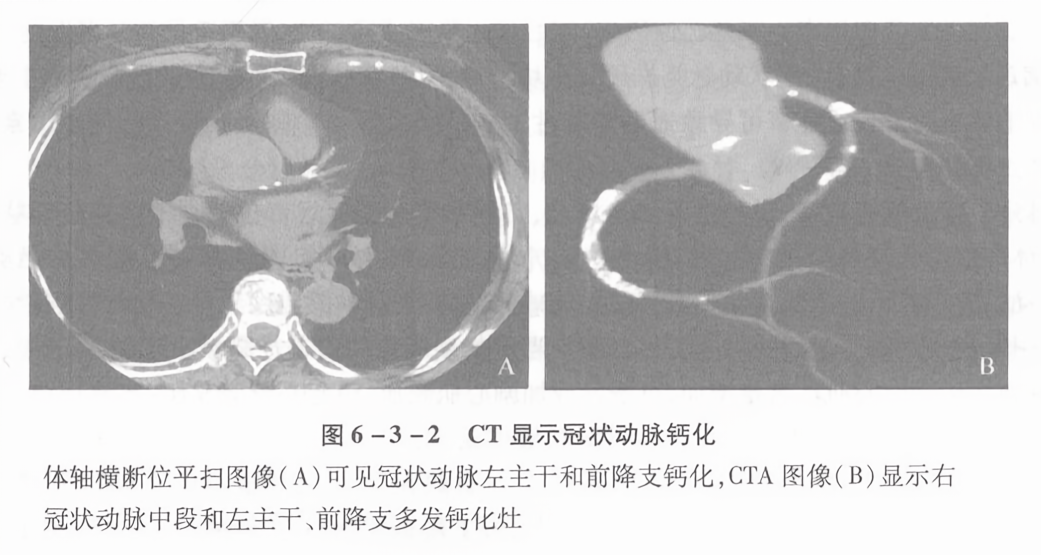 ct显示冠状动脉钙化