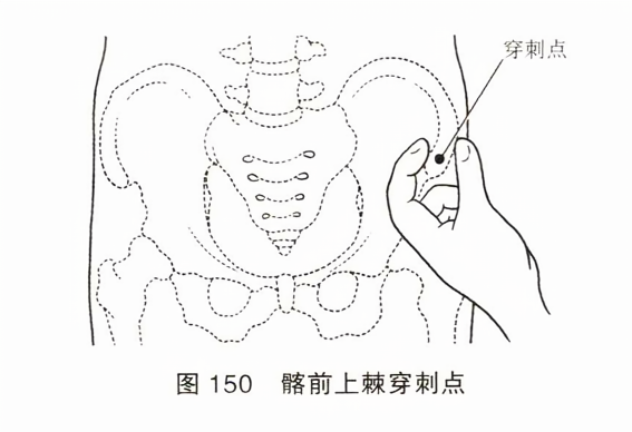 髂前上棘穿刺点