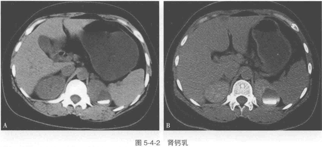 图5-4-2 肾钙乳