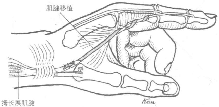 拇长展肌腱
