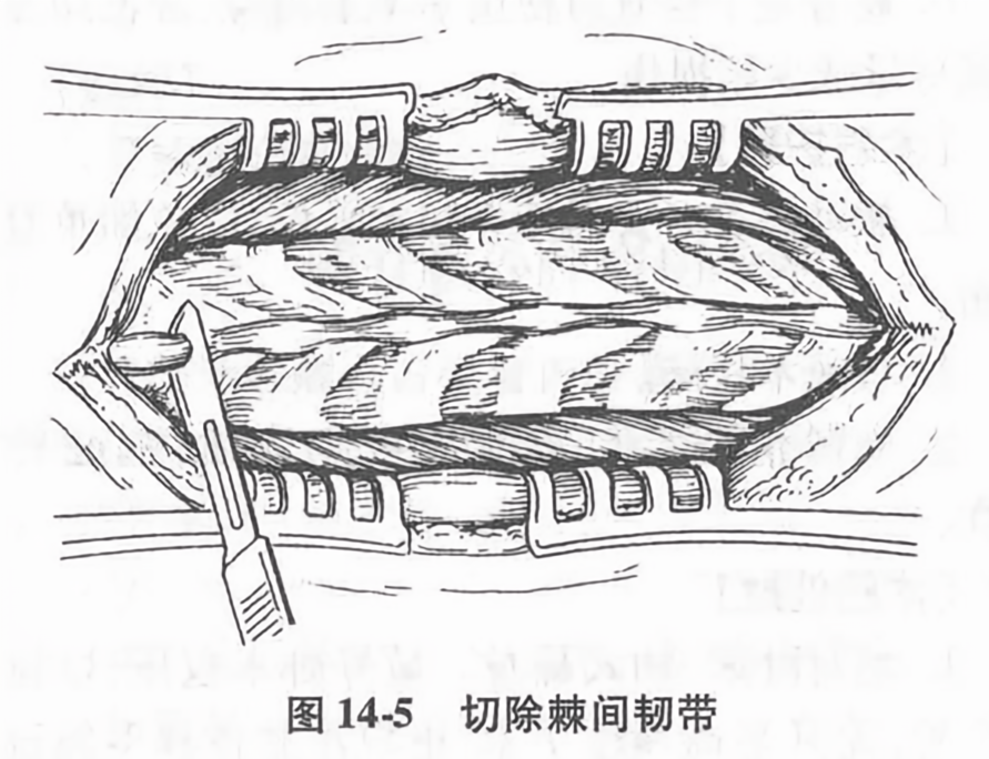 切除棘间韧带