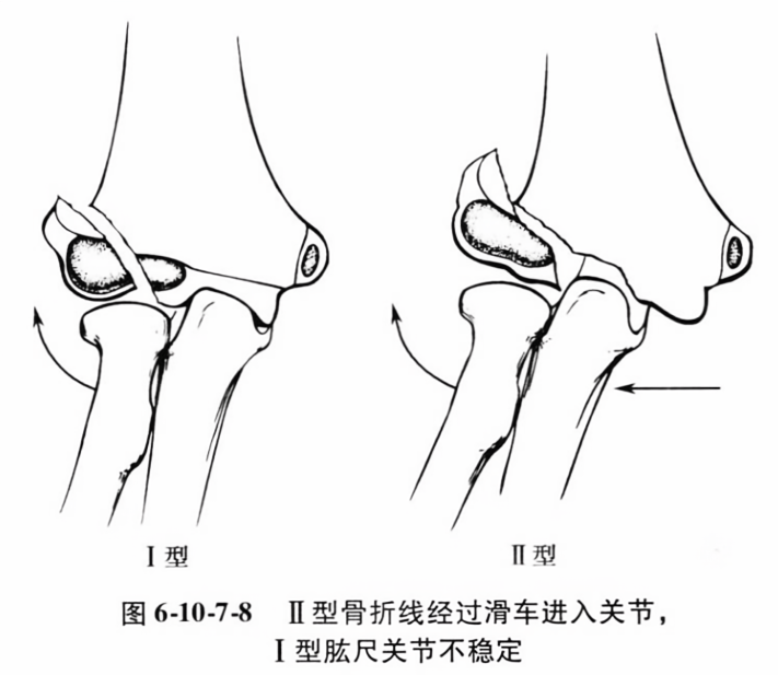 Ⅱ型骨折线经过滑车进入关节i型肱尺关节不稳定
