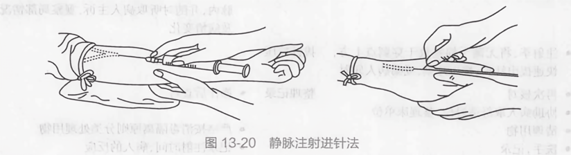 静脉注射进针法