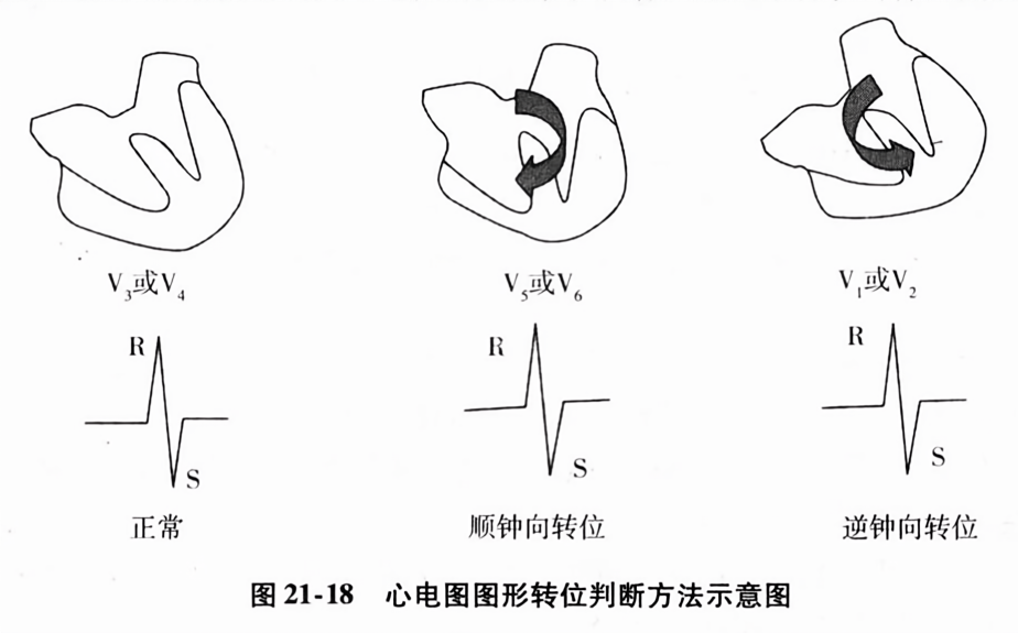 心电图图形转位判断方法示意图